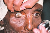 Cataracts